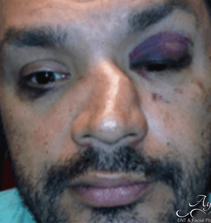 Rhinoplasty Case 9 – Before