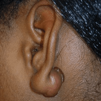 Ear Surgery Case 1 – Before