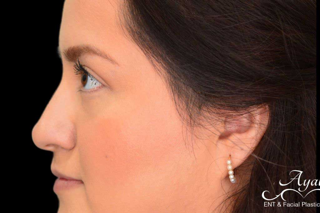 Rhinoplasty Case 52 – Before