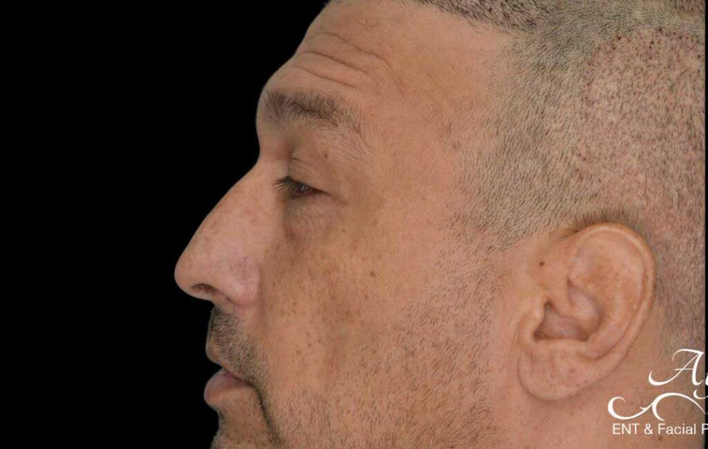 Rhinoplasty Case 53 – Before