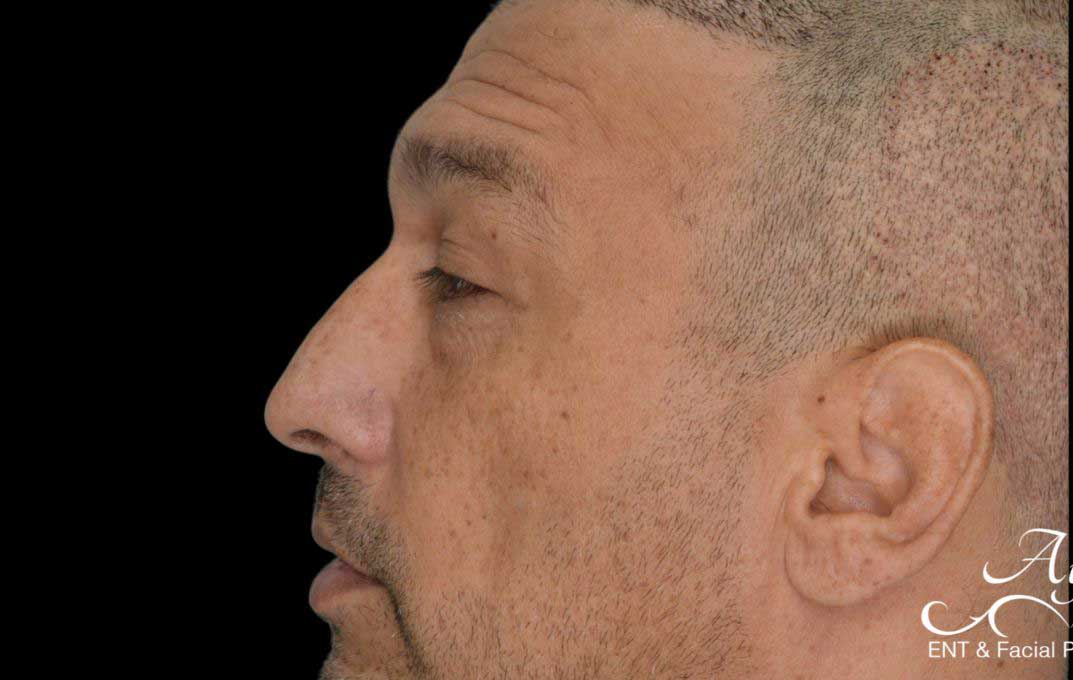 Rhinoplasty Case 53 – Before
