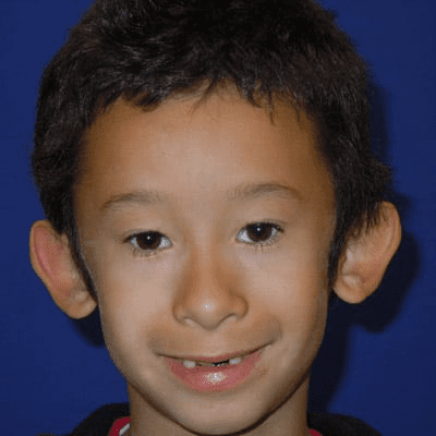 Ear Surgery Case 3 – Before