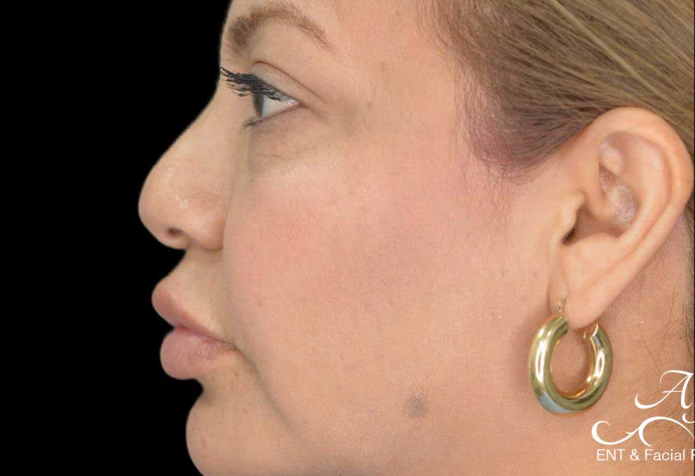 Rhinoplasty Case 54 – Before