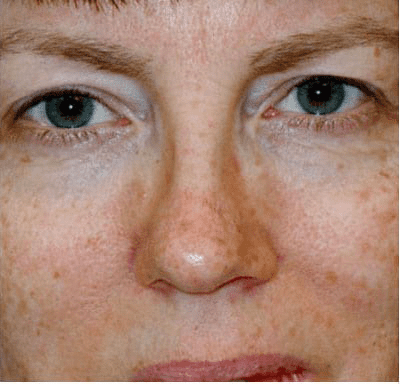 Eyelid Surgery Case 1 – Before