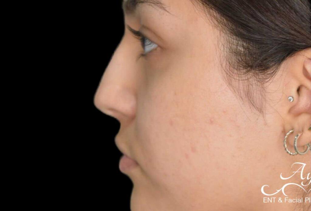 Rhinoplasty Case 55 – Before