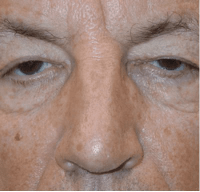 Eyelid Surgery Case 2 – Before