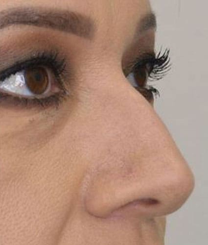 Rhinoplasty Case 28 – Before