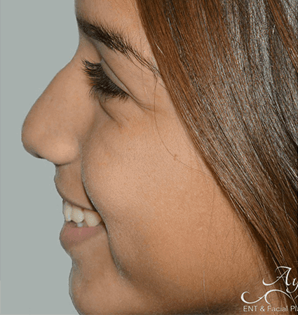 Rhinoplasty Case 12 – Before