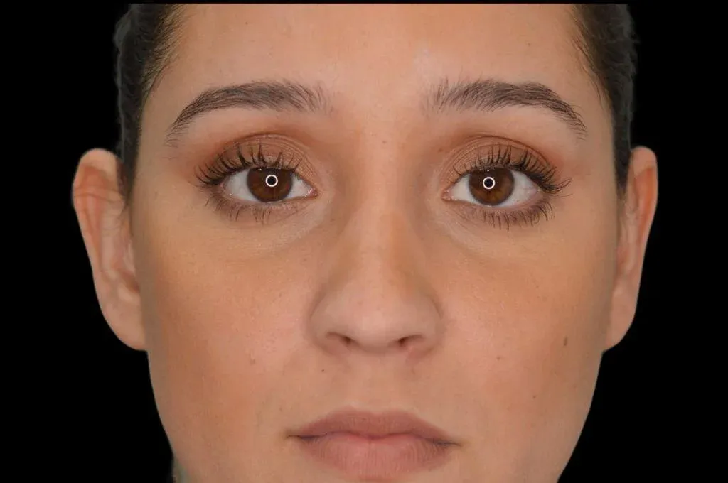 Ear Surgery Case 13 – Before
