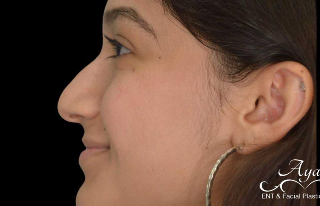 Rhinoplasty Case 56 – Before