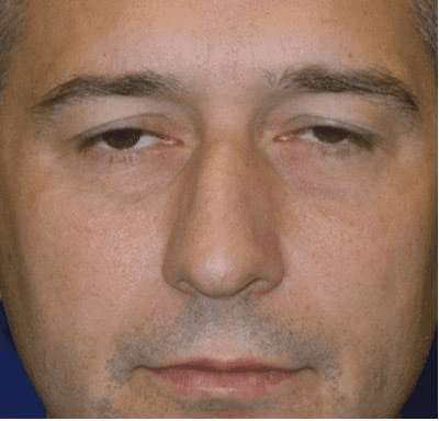 Eyelid Surgery Case 4 – Before