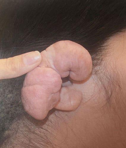 Ear Surgery Case 5 – Before