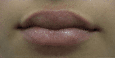 Lip Augmentation Case 1 – Before