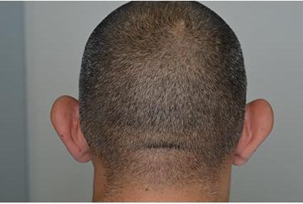 Ear Surgery Case 6 – Before