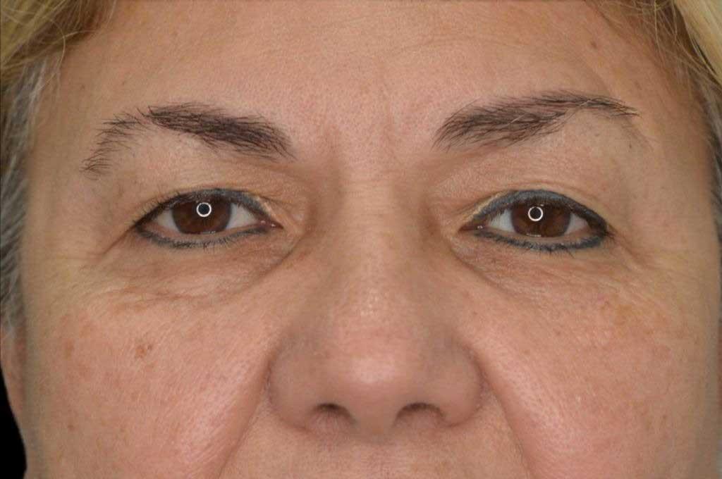 Eyelid Surgery Case 5 – Before