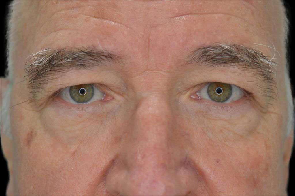 Eyelid Surgery Case 6 – Before