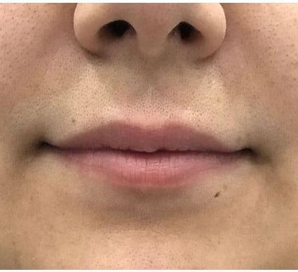 Lip Augmentation Case 5 – Before