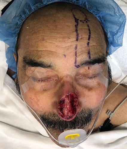 Rhinoplasty Case 29 – Before
