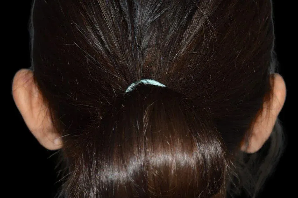 Ear Surgery Case 14 – Before