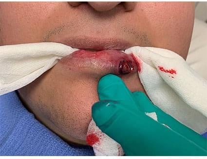 Lip Augmentation Case 6 – Before