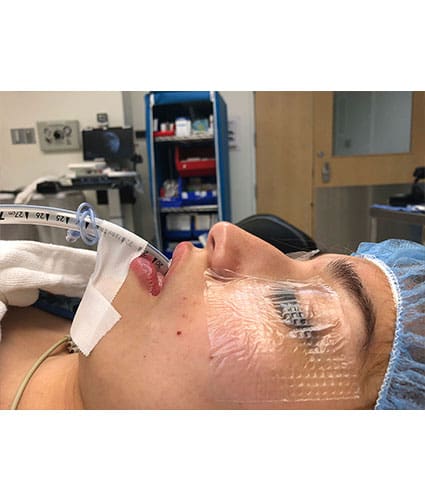 Rhinoplasty Case 30 – Before