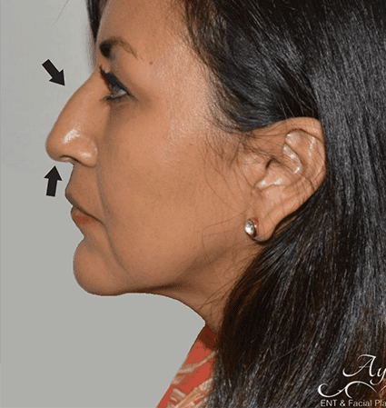 Rhinoplasty Case 14 – Before