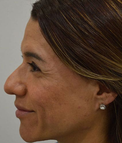 Rhinoplasty Case 31 – Before