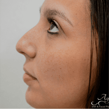Rhinoplasty Case 15 – Before