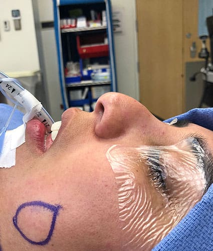 Rhinoplasty Case 32 – Before