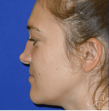 Rhinoplasty Case 16 – Before