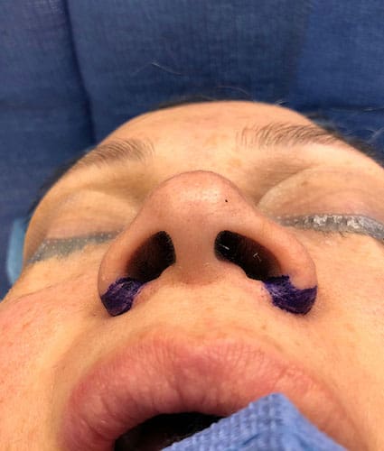 Rhinoplasty Case 33 – Before