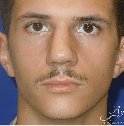 Rhinoplasty Case 17 – Before