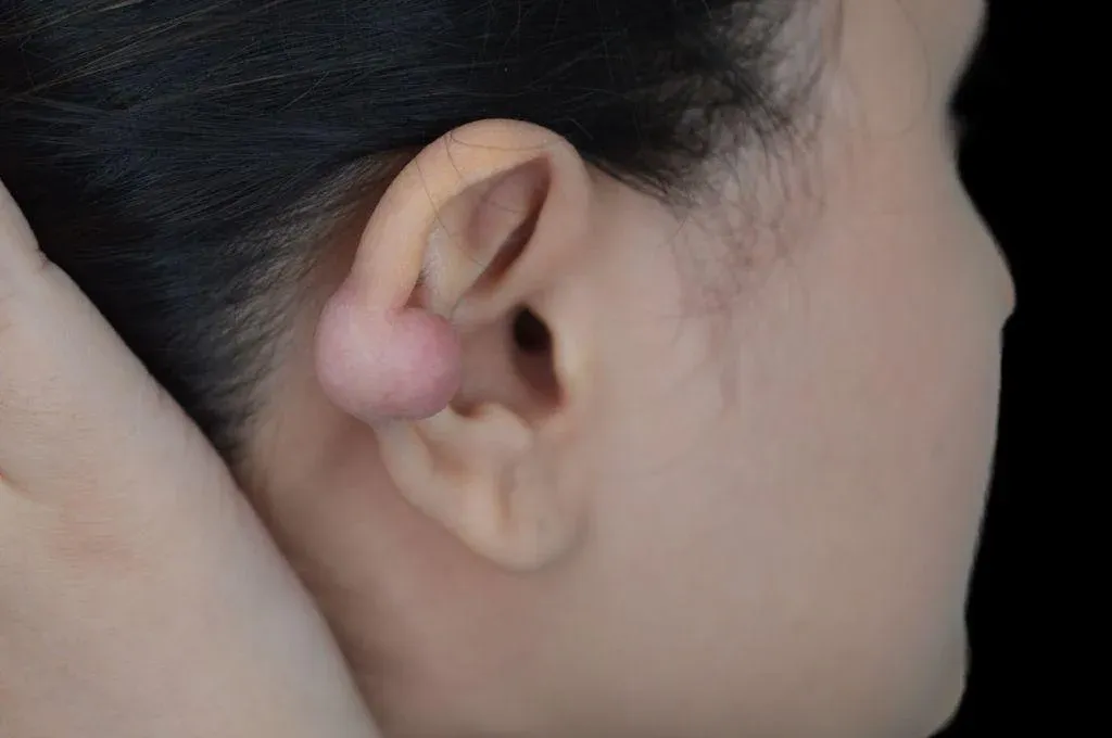 Ear Surgery Case 8 – Before