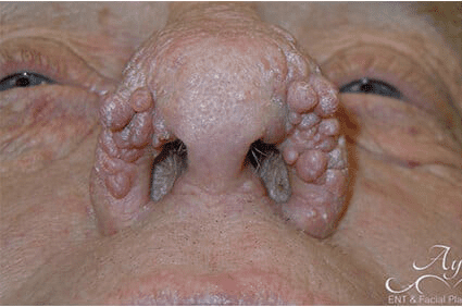 Rhinoplasty Case 18 – Before