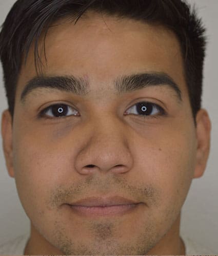 Rhinoplasty Case 25 – Before
