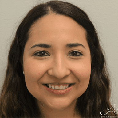 Rhinoplasty Case 1 – Before