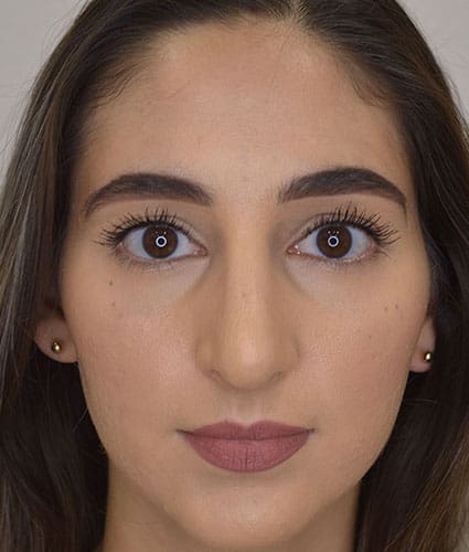 Rhinoplasty Case 26 – After