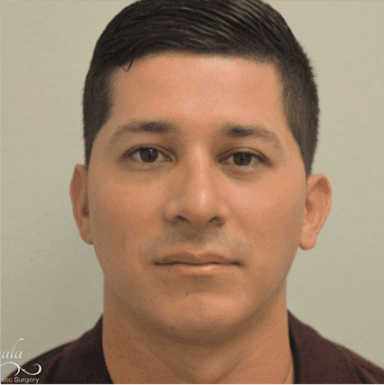 Rhinoplasty Case 10 – After
