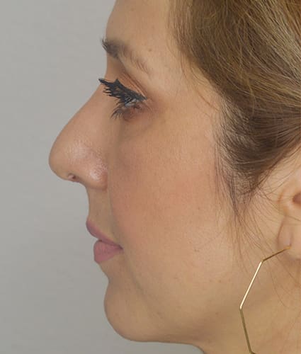 Rhinoplasty Case 35 – After