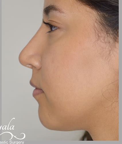 Rhinoplasty Case 36 – After