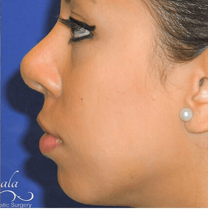 Rhinoplasty Case 20 – After