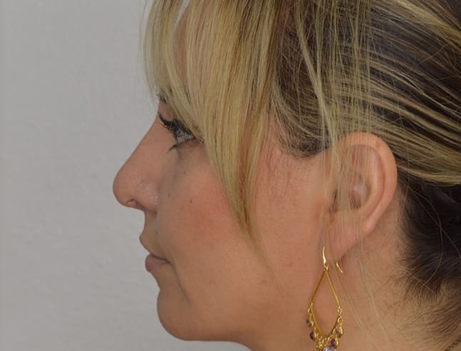 Rhinoplasty Case 39 – After