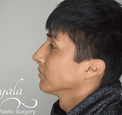 Rhinoplasty Case 22 – After