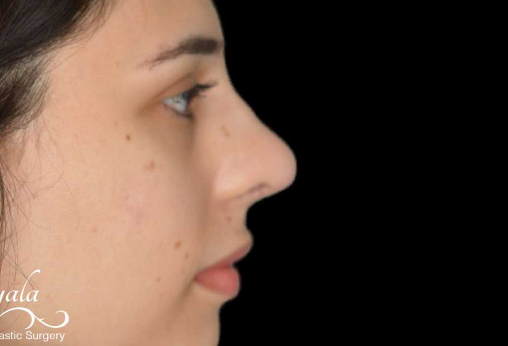 Rhinoplasty Case 41 – After