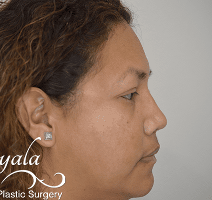 Rhinoplasty Case 23 – After