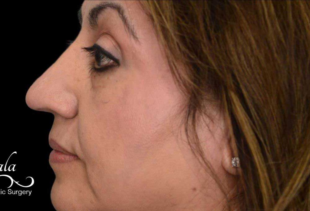 Rhinoplasty Case 42 – After