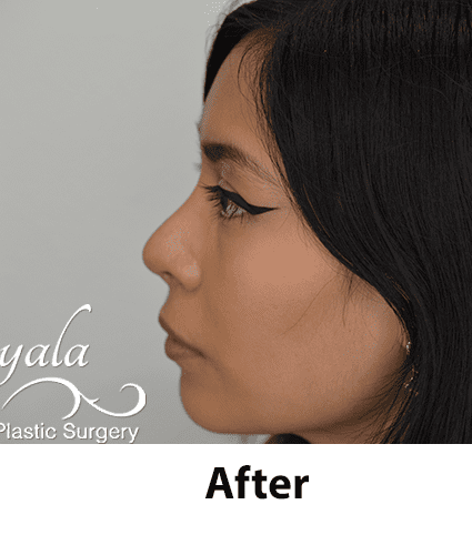 Rhinoplasty Case 24 – After