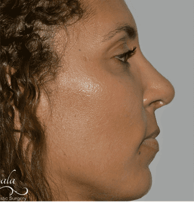 Rhinoplasty Case 3 – After
