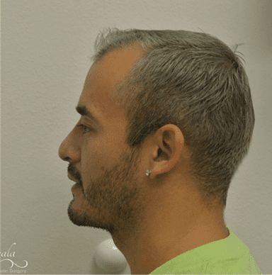Rhinoplasty Case 4 – After
