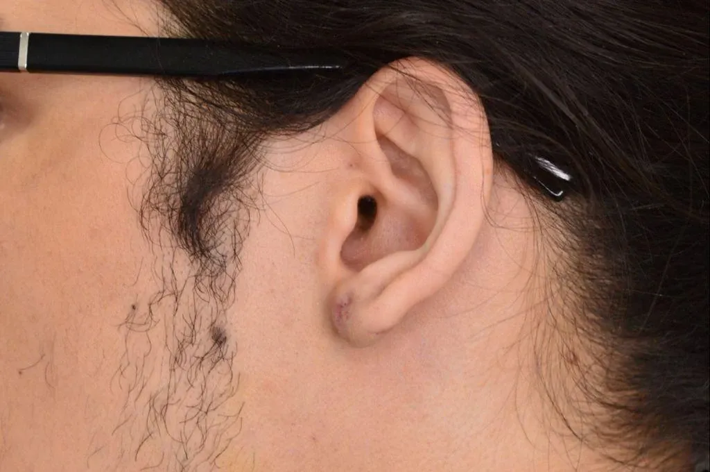 Ear Surgery Case 12 – After